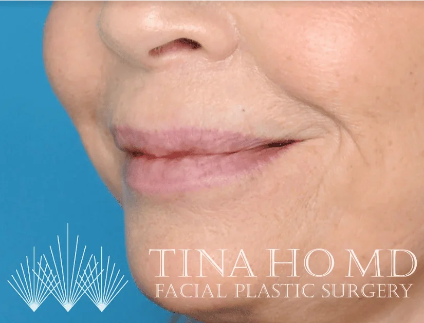 After lip filler showing fuller, more defined lips