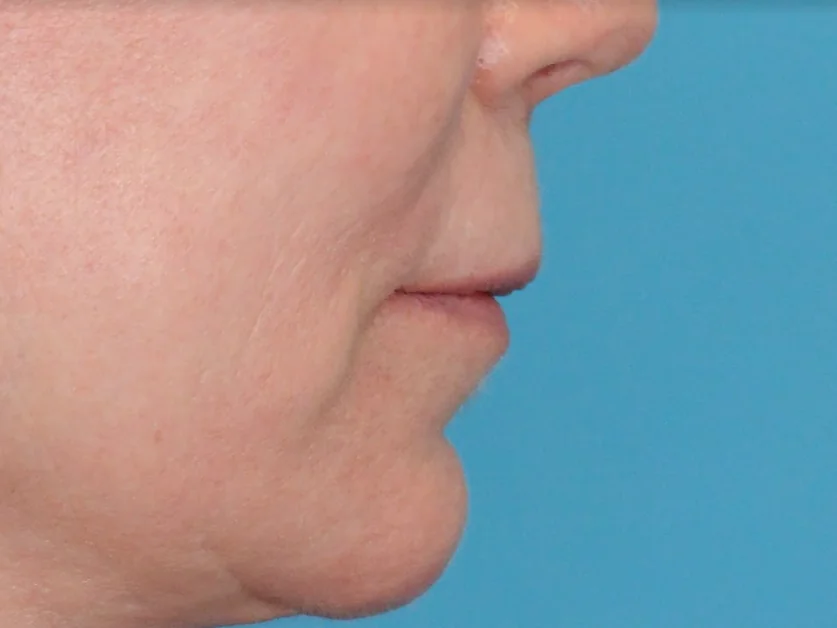 Before lip filler showing a person's natural lips