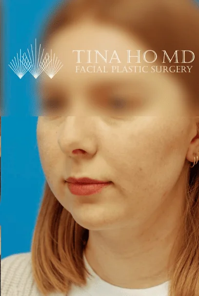 Patient's face after chin, neck and submental liposuction