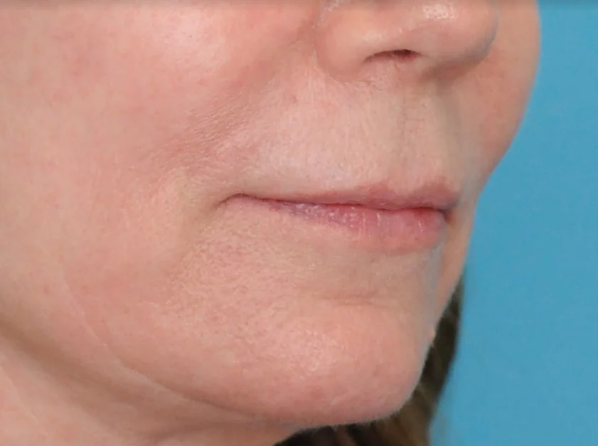 Before lip filler showing a person's natural lips