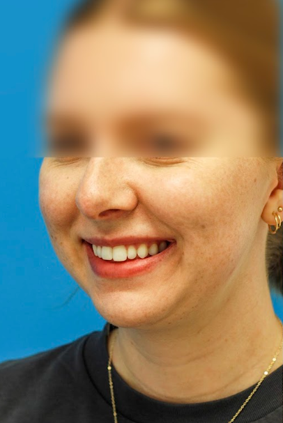 Patient's face before chin, neck and submental liposuction