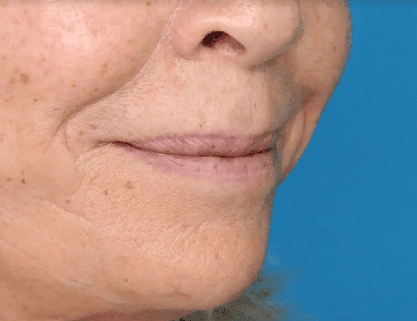 Before lip filler showing a person's natural lips