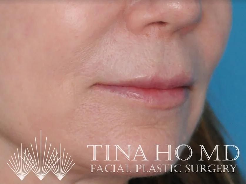 After lip filler showing fuller, more defined lips