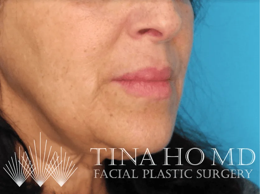 After lip filler showing fuller, more defined lips