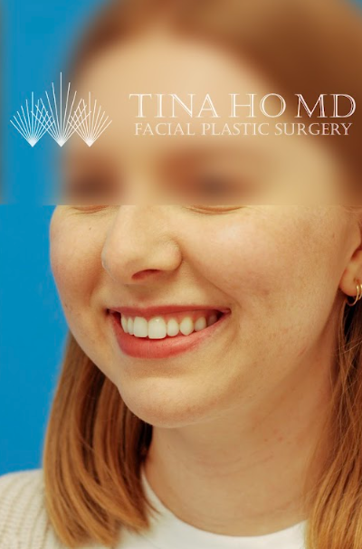 Patient's face after chin, neck and submental liposuction