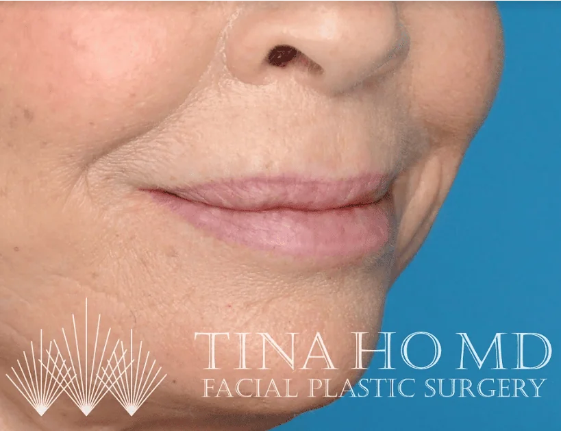 After lip filler showing fuller, more defined lips