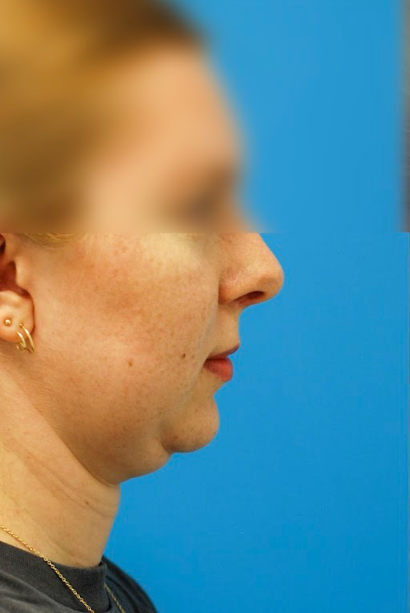 Patient's face before chin, neck and submental liposuction