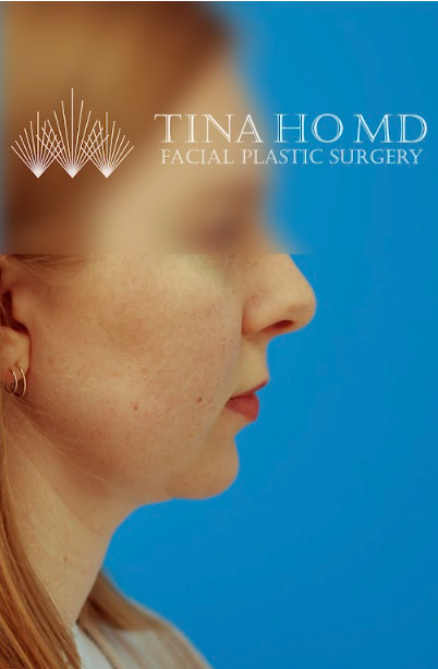 Patient's face after chin, neck and submental liposuction