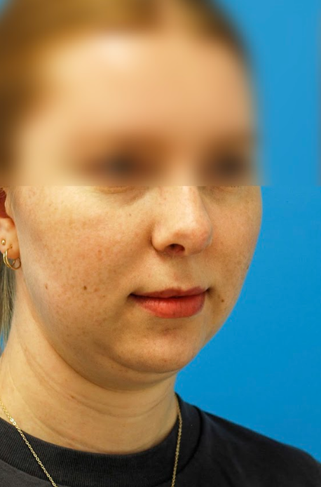 Patient's face before chin, neck and submental liposuction