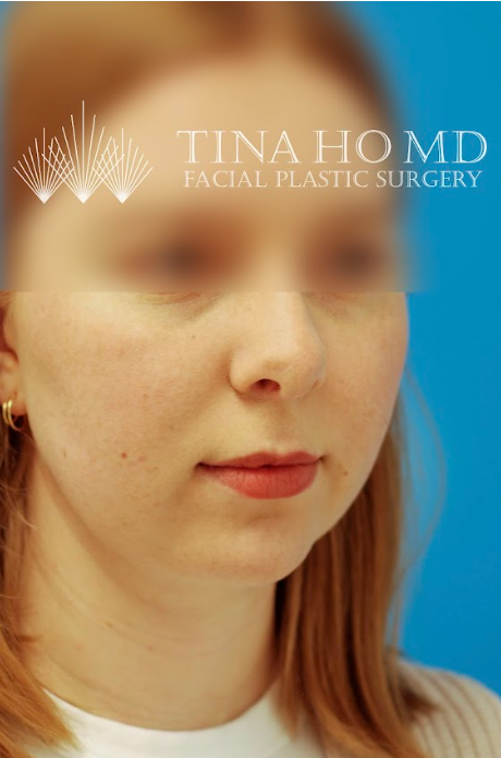 Patient's face after chin, neck and submental liposuction