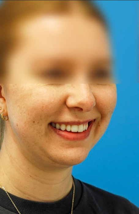 Patient's face before chin, neck and submental liposuction