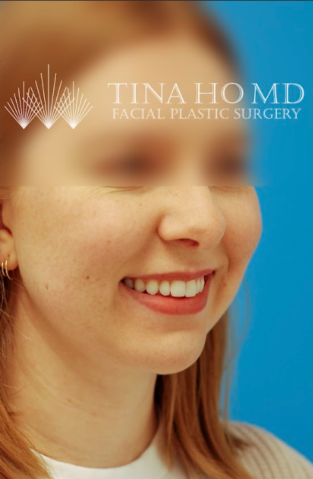 Patient's face after chin, neck and submental liposuction