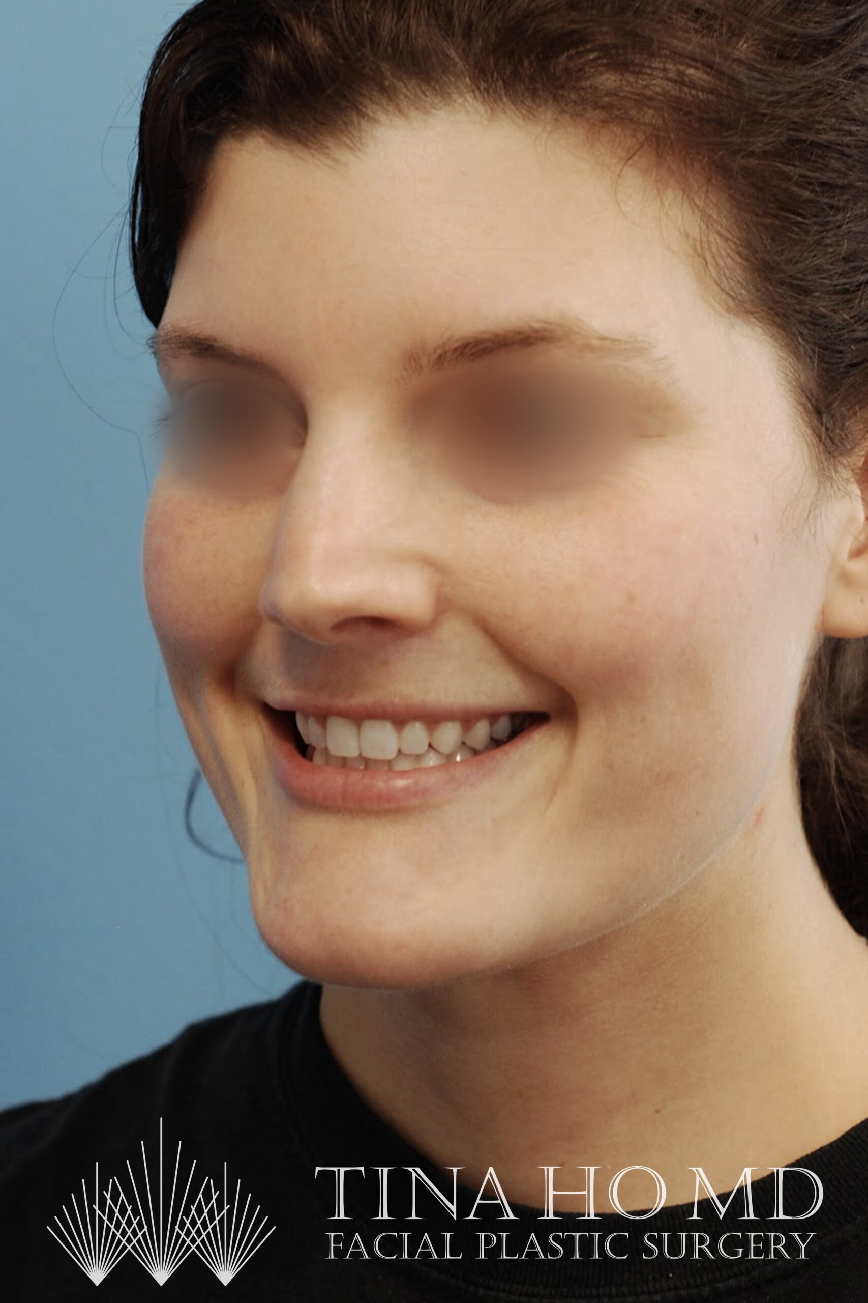 Necklift-After