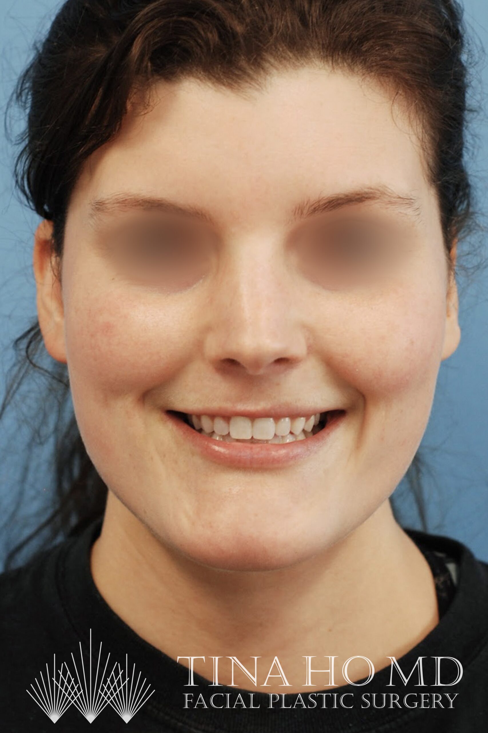 Necklift-After