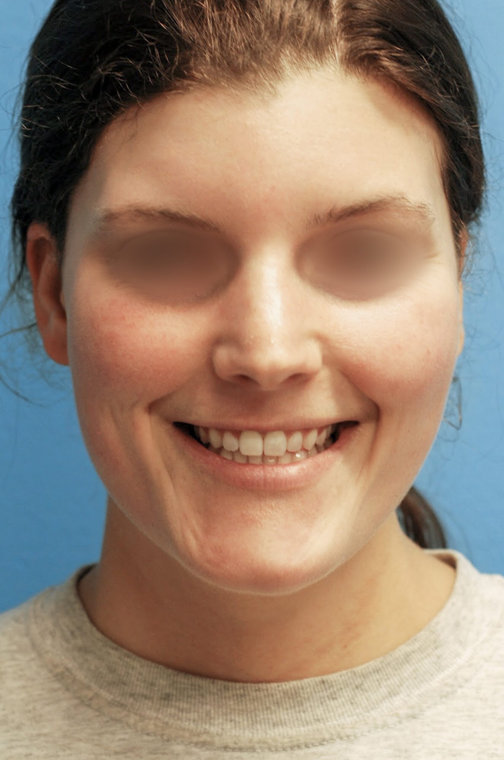 Necklift-Before