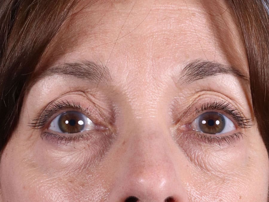Woman's lips before dermal filler injection for enhancement
