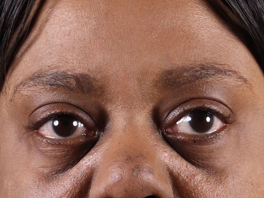 Woman's face before dermal filler treatment, showing subtle lines