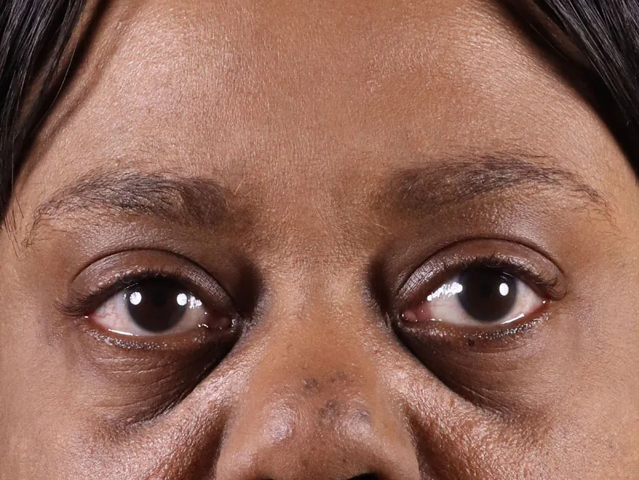 Woman's face before dermal filler treatment, showing subtle lines