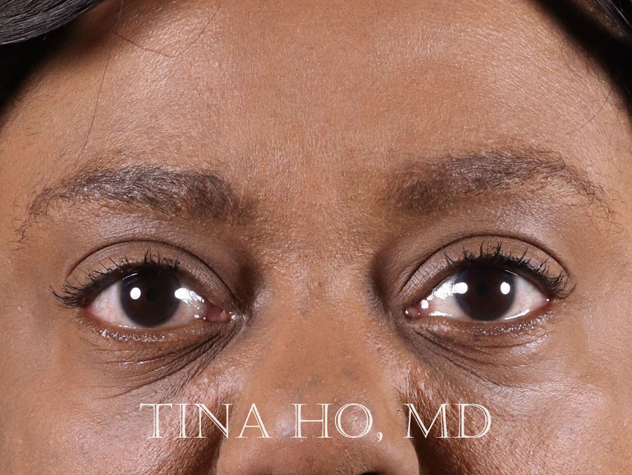 Woman's face after dermal filler treatment, with softened lines