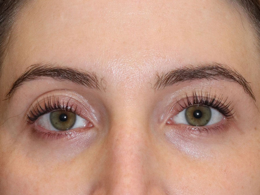 Female patient's lips before Philadelphia dermal filler treatment