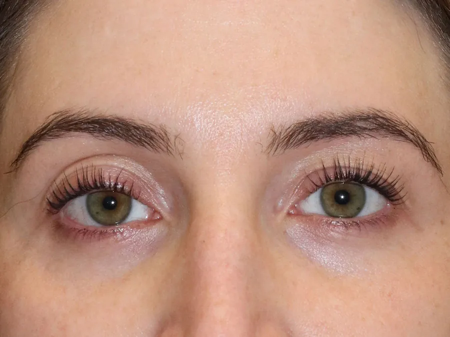 Female patient's lips before Philadelphia dermal filler treatment