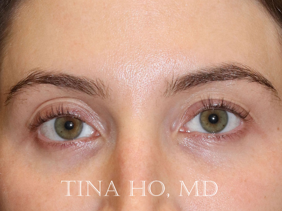 Female patient's lips after Philadelphia dermal filler treatment