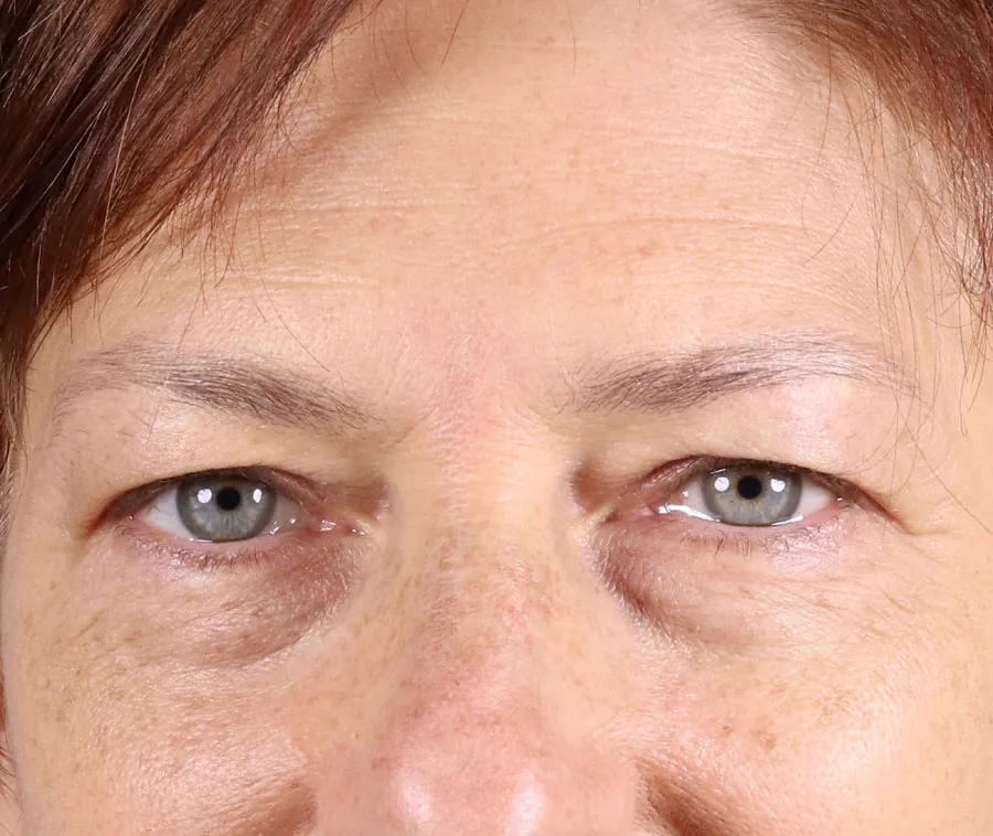 Patient's lower face before injectables to improve jawline contour