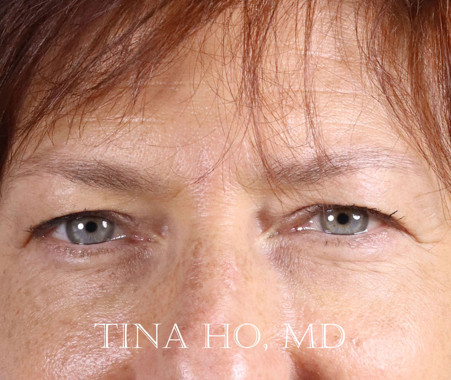 Patient's lower face after injectables, showing improved jawline contour