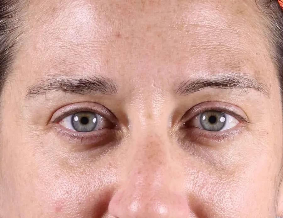 Female patient's undereyes before fillers, showing hollowness