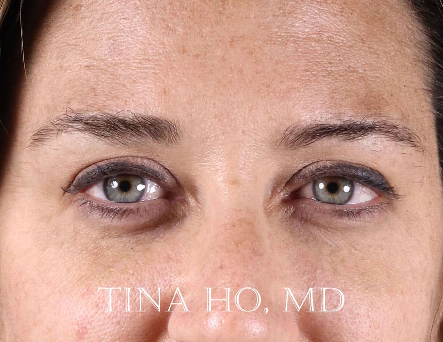 Female patient's undereyes after fillers, showing volume restoration