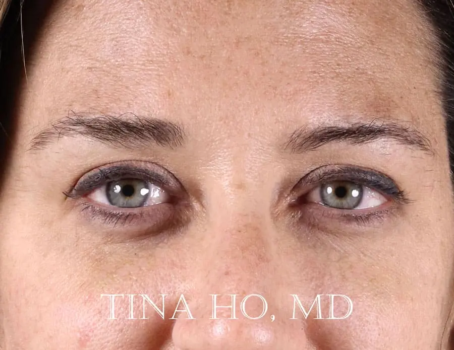 Female patient's undereyes after fillers, showing volume restoration