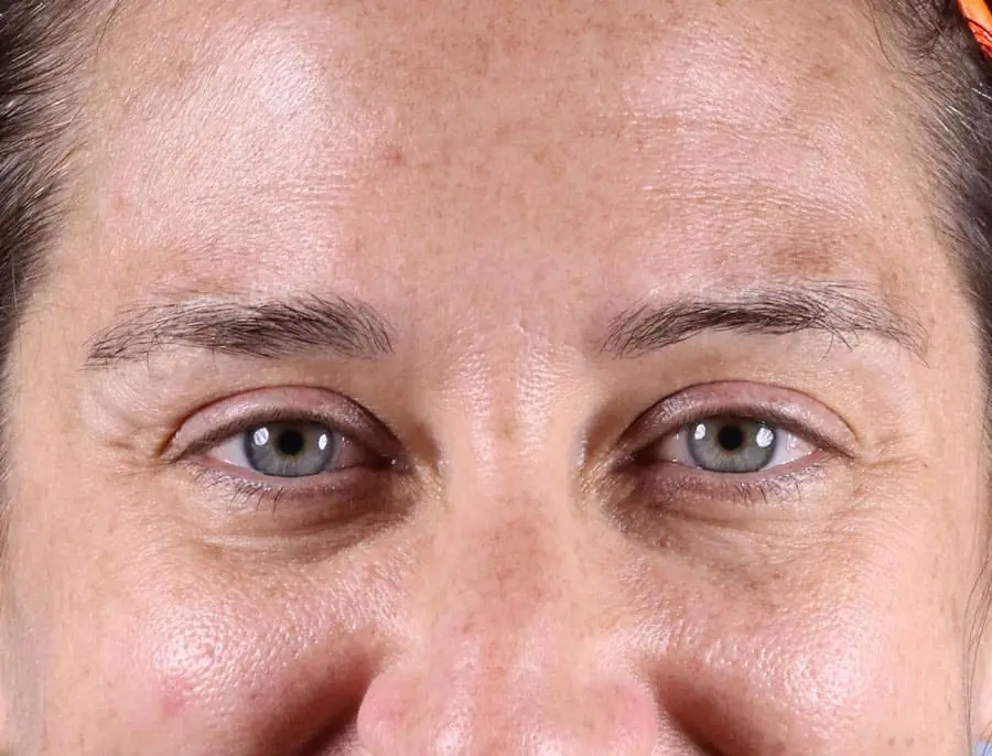 Female patient's profile before fillers, showing tear trough depression