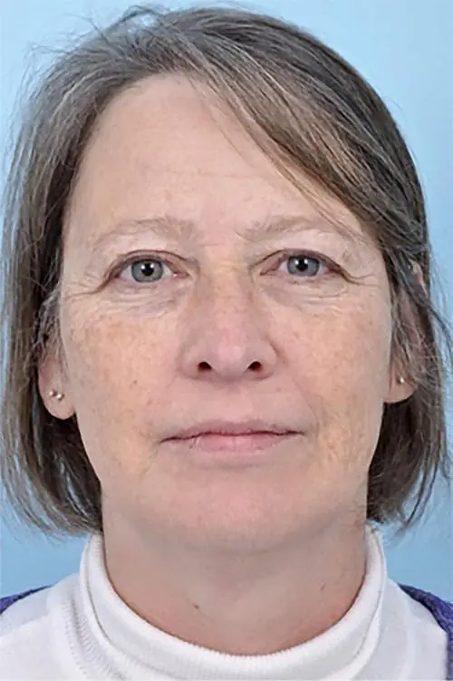 Patient's profile before facial injectables, showing areas for treatment