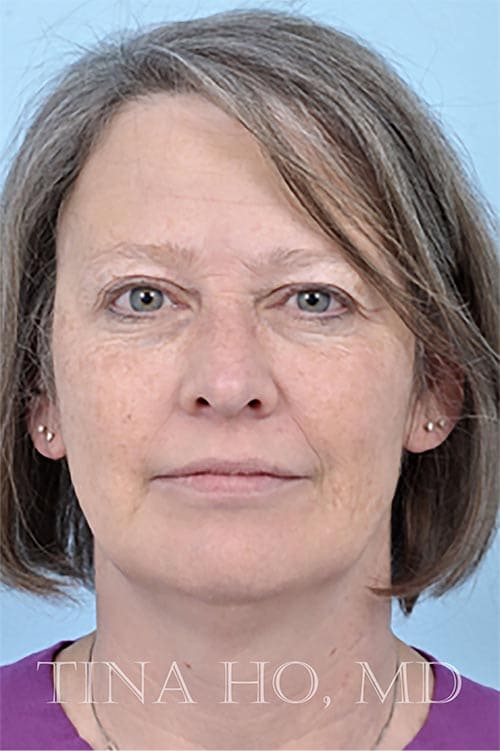 Patient's profile after facial injectables, showing improved contours