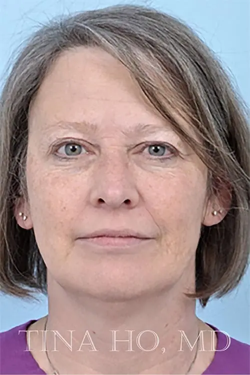 Patient's profile after facial injectables, showing improved contours