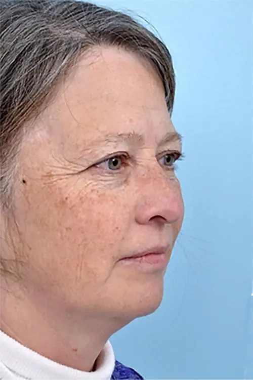 Patient's side profile before facial injectables, showing volume loss