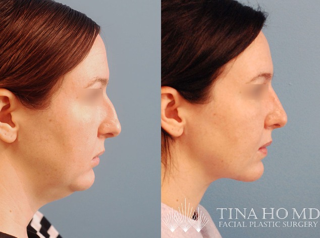 rhinoplasty