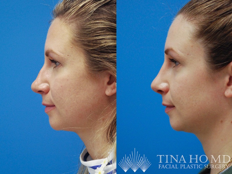 rhinoplasty