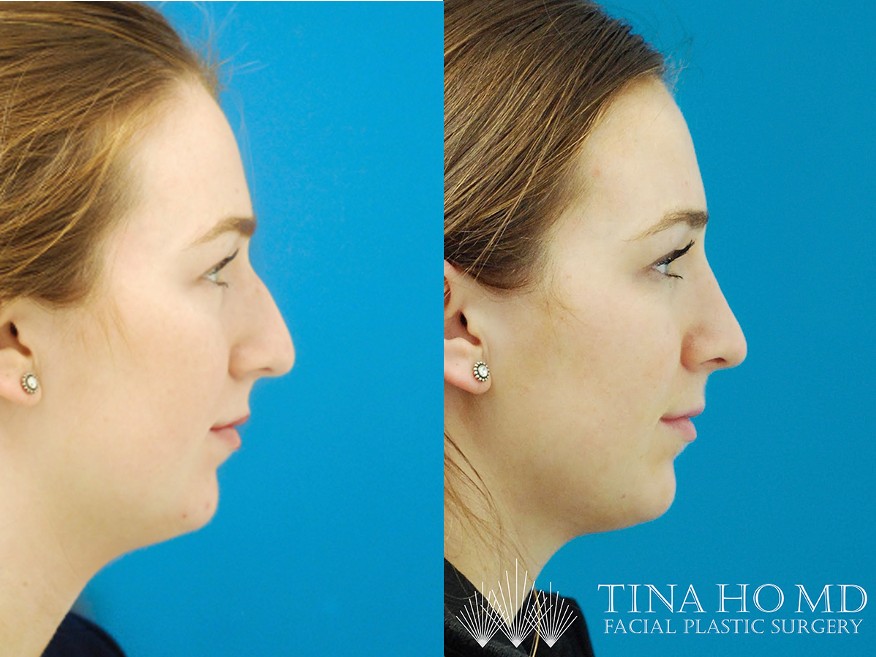 rhinoplasty