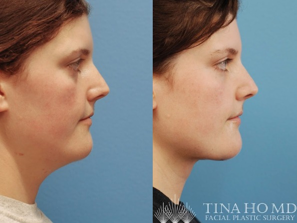 necklift