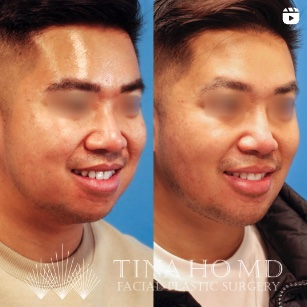 Injectables facial contouring