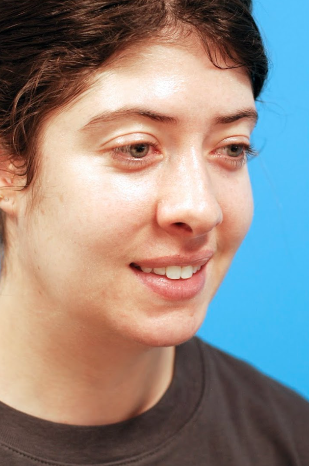 Patient's face before jawline contouring procedure