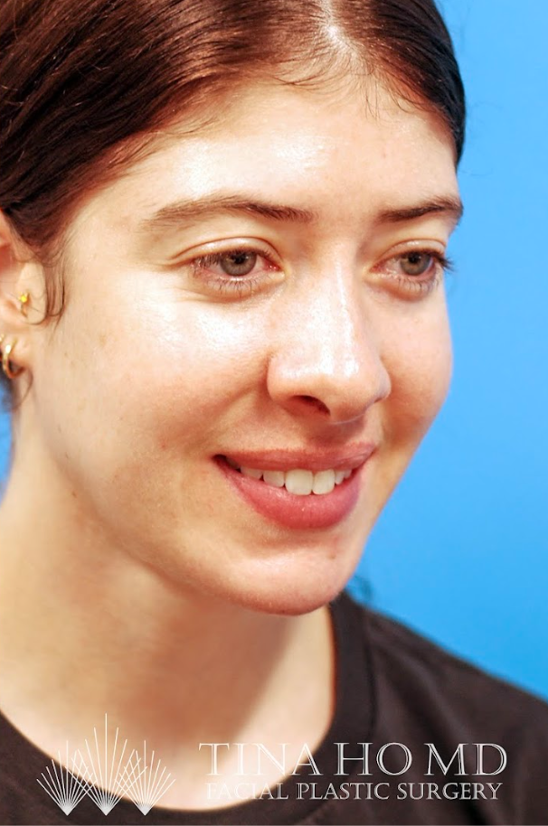 Patient's face after jawline contouring procedure