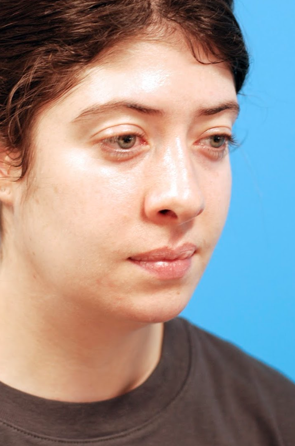 Patient's face before jawline contouring procedure