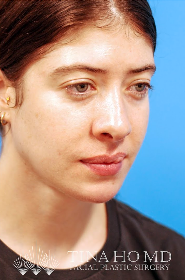 Patient's face after jawline contouring procedure