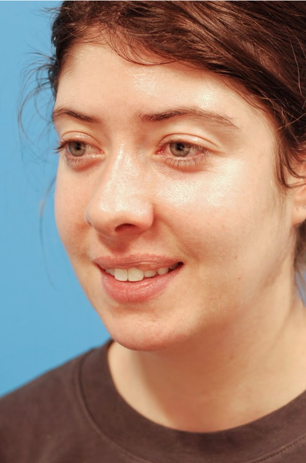 Patient's face before jawline contouring procedure