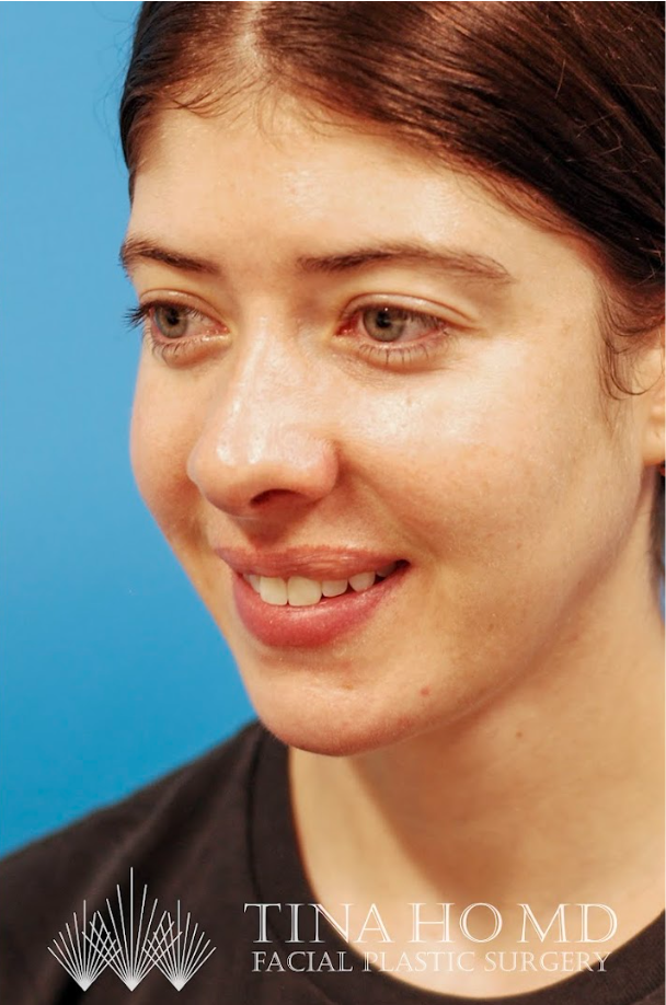 Patient's face after jawline contouring procedure