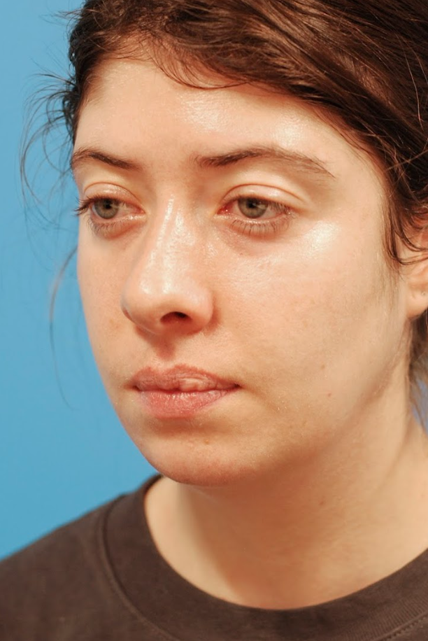 Patient's face before jawline contouring procedure