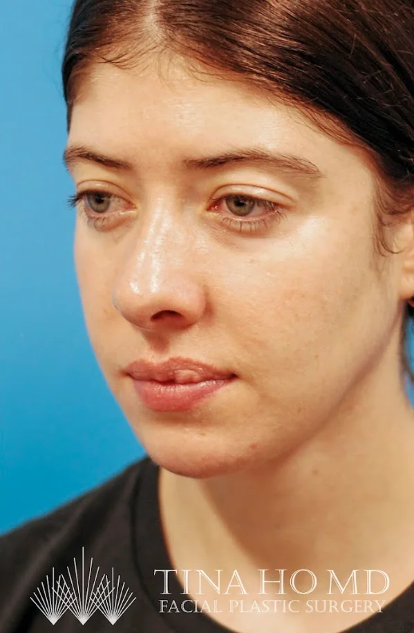 Patient's face after jawline contouring procedure