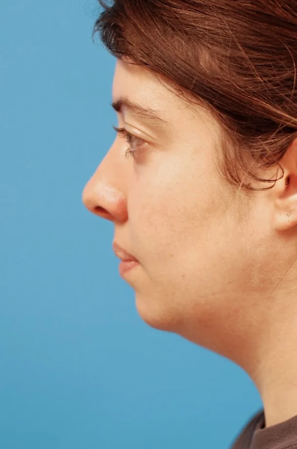 Patient's face before jawline contouring procedure